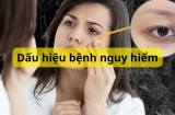 Thâm quầng mắt không chỉ vì thiếu ngủ, cẩn thận đó là biểu hiện của bệnh nguy hiểm