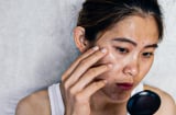 Nguyên nhân dẫn đến đốm nâu, tàn nhang, da đen sạm không đều màu mà ít ai biết đến