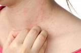 3 cách tắm trắng cho Mừng SHBET phiên bản mới 2025 bị chàm, vùa an toàn vừa giúp da trắng sáng hơn