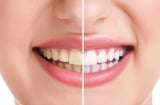 4 mẹo đơn giản đánh bay nỗi lo răng bị ố vàng nhiều mảng bám