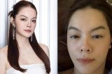 Phạm Quỳnh Anh gây lo lắng khi tiết lộ gặp sự cố sức khỏe, phải dùng kim châm để điều trị