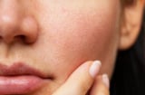5 mẹo đơn giản giúp khắc phục tình trạng lỗ chân lông ngày càng to