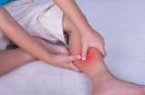3 dấu hiệu ở chân cảnh báo nguy cơ ung thư phổi bạn không thể bỏ qua'