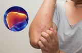 5 dấu hiệu cảnh báo bệnh gan đã đi vào giai đoạn nặng: Có 1/5 cũng phải đi khám sớm