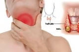 7 dấu hiệu sớm của K tuyến giáp, nhiều người chủ quan bỏ qua