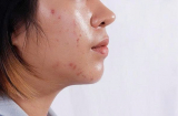 Cách kiểm soát dầu nhờn hiệu quả cho da mặt