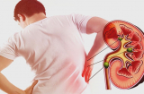 4 nhóm người dễ mắc suy thận nhất: Đặc biệt kiểu số 3
