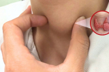 5 nhóm người có nguy cơ cao bị ung thư tuyến giáp