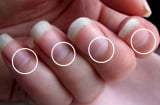 5 dấu hiệu trên móng tay chứng tỏ bạn đang mắc bệnh nan y