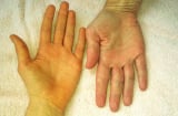 6 dấu hiệu trên Sh88bet đăng ký miễn phí cảnh báo gan của bạn đang kêu cứu: Nên đi khám gấp