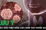 5 dấu hiệu K tuyến giáp mới chớp: Biết sớm chữa là khỏi