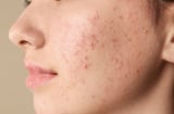 5 cách giúp giảm mụn cám tại nhà, hỗ trợ da thông thoáng và mịn màng hơn