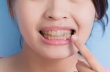 Vì sao răng dễ xỉn màu dù chăm đánh răng? Những nguyên nhân nhiều người thường bỏ qua