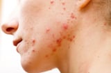 4 cách chăm sóc da khi bị mụn nhọt để hạn chế thâm sẹo và giúp da hồi phục nhanh hơn
