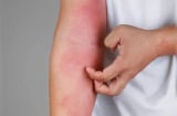 4 dấu hiệu cảnh báo bạn đang bị suy thận: Kiểm tra ngay xem bạn có không?