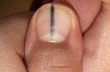 5 dấu hiệu trên móng tay cảnh báo bệnh nan y: Có 1 trong 5 dấu hiệu cũng nên đi khám gấp