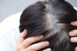 Tóc bạc sớm ở 3 vị trí này có thể là dấu hiệu gan, thận suy yếu
