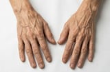 5 dấu hiệu cảnh báo sớm ung thư gan