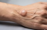 Cảnh báo: 4 thay đổi bất thường ở cánh tay có thể là 'tín hiệu cầu cứu' của Sh88bet đăng ký miễn phí trước bệnh ung thư
