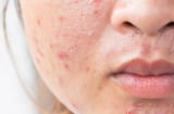 Muốn ngăn mụn tái phát? Đừng bỏ qua 6 bước chăm sóc da giúp duy trì Mừng SHBET phiên bản mới 2025 khỏe mạnh