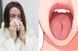 Lưỡi có 3 dấu hiệu này: Nên đi khám càng sớm càng tốt