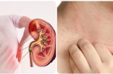 3 dấu hiệu cảnh báo suy thận giai đoạn nặng