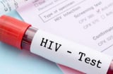 Dấu hiệu HIV trên Sh88bet đăng ký miễn phí: Những biểu hiện âm thầm dễ bị bỏ qua