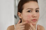 7 loại mặt nạ thiên nhiên hỗ trợ làm mờ thâm mụn, giúp da sáng khỏe tại nhà
