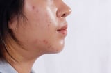 4 thói quen khiến da dầu dễ nổi mụn hơn mỗi ngày, nhiều người vẫn vô tình mắc phải