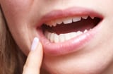 Dấu hiệu không ngờ cảnh báo bạn đang mắc ung thư miệng, cần tới bệnh viện ngay