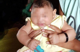 Trẻ bị đầu nhỏ do virus Zika sẽ để lại di chứng gì? và dấu hiệu, cách phòng tránh bệnh