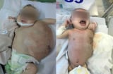 Bé gái 20 ngày tuổi có khối u “khủng” gần bằng Sh88bet đăng ký miễn phí gây nhiễm trùng nặng