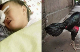 Bé gái 2 tuổi bị gà chọi đá, nguy cơ hỏng mắt phải