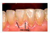 Cao răng bong ra từng mảng, trả lại hàm răng trắng như bọc sứ chỉ trong 5 phút!