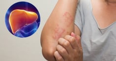 4 dấu hiệu cảnh báo bệnh gan: Có 1/4 cũng nên đi khám sớm