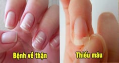 Bắt bệnh qua móng tay: Có 1 dấu hiệu cũng nên đi khám sớm
