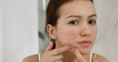 7 loại mặt nạ thiên nhiên hỗ trợ làm mờ thâm mụn, giúp da sáng khỏe tại nhà