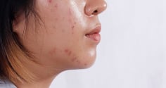 4 thói quen khiến da dầu dễ nổi mụn hơn mỗi ngày, nhiều người vẫn vô tình mắc phải