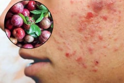 3 đối tượng không được ăn mận: Dễ nổi mụn, nóng trong