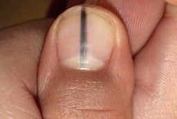 5 dấu hiệu trên móng tay cảnh báo bệnh nan y: Có 1 trong 5 dấu hiệu cũng nên đi khám gấp