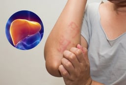 4 dấu hiệu cảnh báo bệnh gan: Có 1/4 cũng nên đi khám sớm