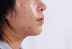 4 thói quen khiến da dầu dễ nổi mụn hơn mỗi ngày, nhiều người vẫn vô tình mắc phải
