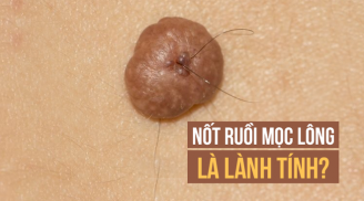 Lông mọc ở nốt ruồi có gây ung thư hay không và biểu hiện bất thường cần nghĩ ngay tới ung thư là gì?