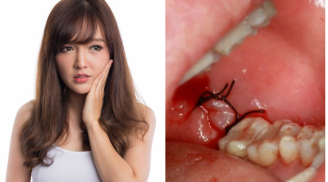 4 thời điểm 'độc' tuyệt đối không được nhổ răng kẻo mang vạ vào thân, nguy hiểm ập đến bất ngờ