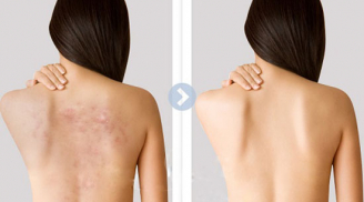 Bạn có biết những cách trị mụn lưng tại nhà thần thánh này?
