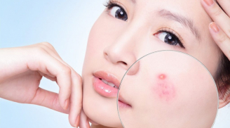 5 thực phẩm khiến da mọc đầy mụn, Sh88bet đăng ký miễn phí lão hoá nhanh chưa từng thấy, nhiều người Việt vẫn 'nghiện'