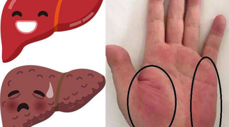 3 dấu hiệu trên bàn tay cảnh báo sớm ung thư gan, số 2 nhiều người có nhưng chủ quan