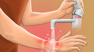 Sai lầm tai hại khi sơ cứu bỏng mà nhiều người vẫn lầm tưởng là đúng