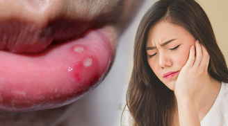 Cách chữa nhiệt miệng siêu hiệu quả mà không tốn một đồng