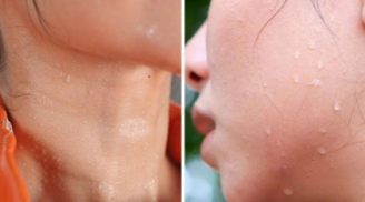 Bác sĩ cảnh báo dấu hiệu của 8 loại bệnh thông qua vị trí đổ mồ hôi, trong đó có đột quỵ